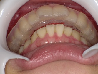 スプリント（ナイトガード）